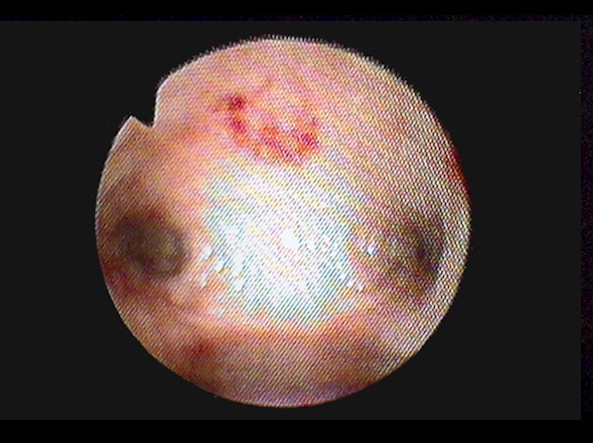 Atrophic Endometrium