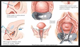 pictures of cystocele