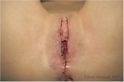 labiavaginoplasty