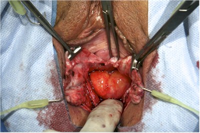 Enterocele Enterocele