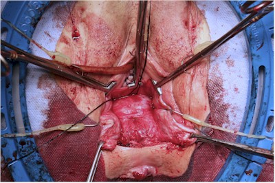 Double Bump Sign of and Rectocele and Enterocele Double Bump Sign of and Rectocele and Enterocele