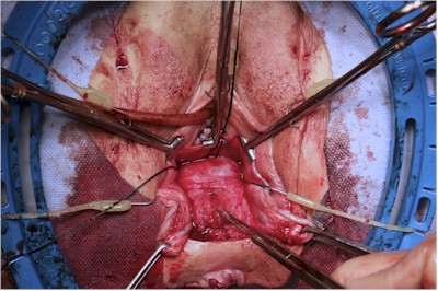 Pointing at the Rectocele Pointing at the Rectocele