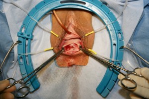Uterine Suspension