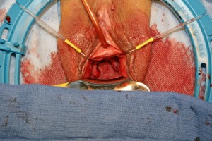 Uterine Suspension