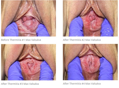 Thermiva Case Study 2